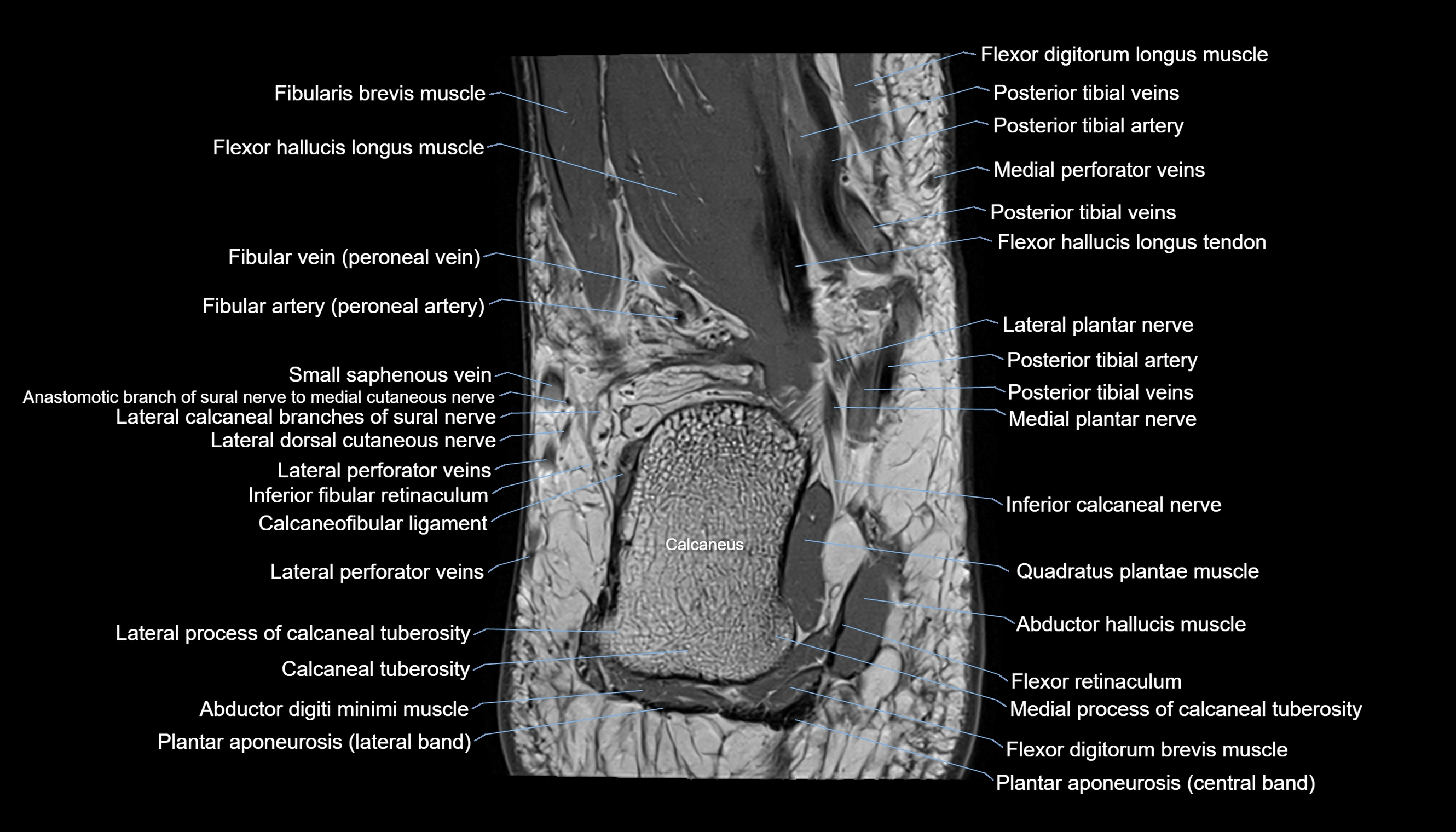 Ankle coronal anatomy 3T MRI images -img-11001-00021.webp